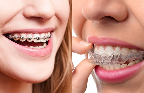 Starting The School Year With Braces Or Invisalign